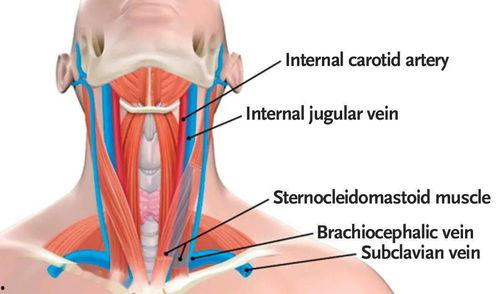 颈内静脉穿刺视频,颈内静脉穿刺操作步骤及要点解析